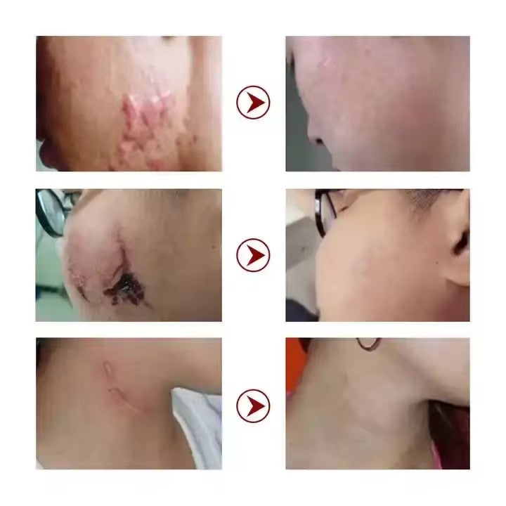 CRÈMES CICATRICES ET VERGETURES