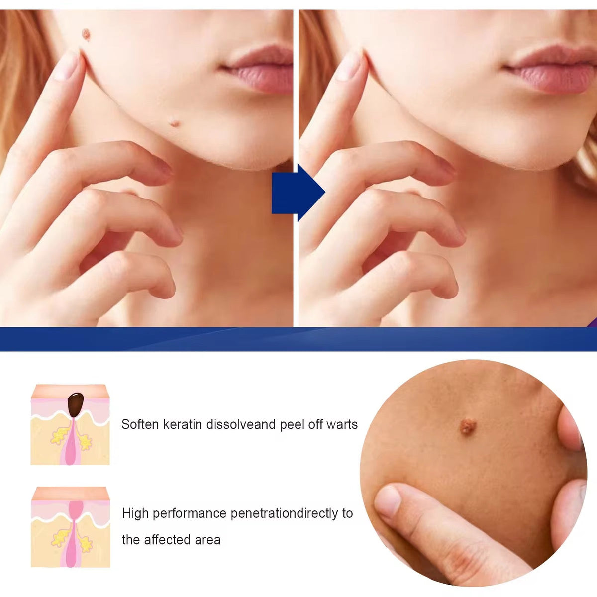 Crème pour enlever les verrues, indolore, sérum pour enlever les grains de beauté, les taches brunes, les verrues