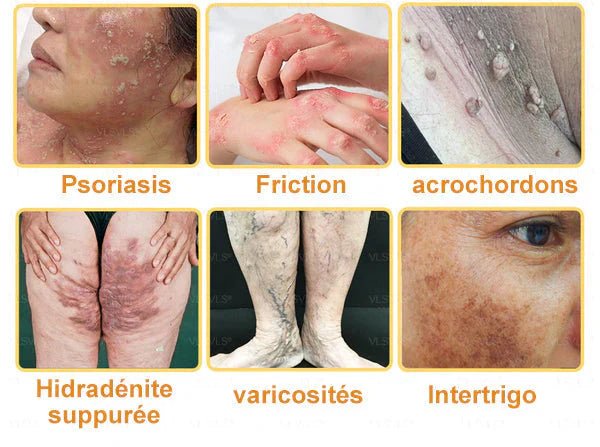 Venin d'abeille Crème de traitement de l'arthrite au venin d'abeille