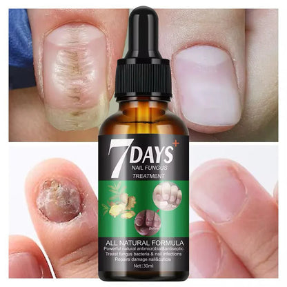 Traitement anti-mycoses des ongles