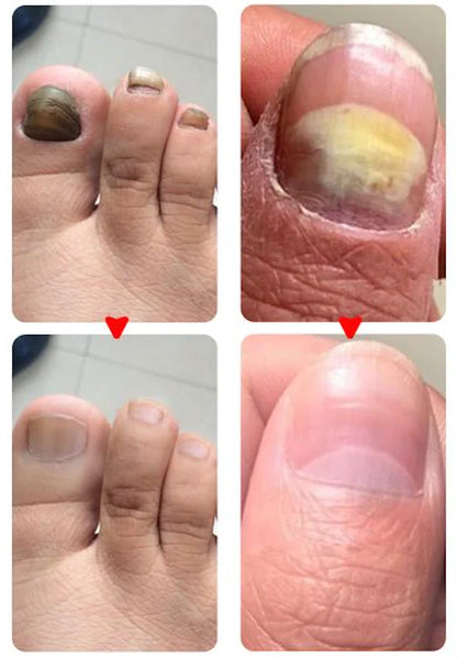 Traitement anti-mycoses des ongles (7 jours)