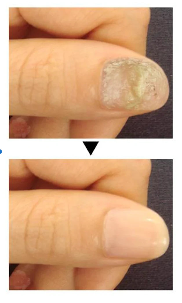 Traitement anti-mycoses des ongles (7 jours) (C)