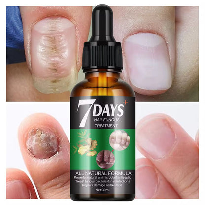 Traitement anti-mycoses des ongles (7 jours)
