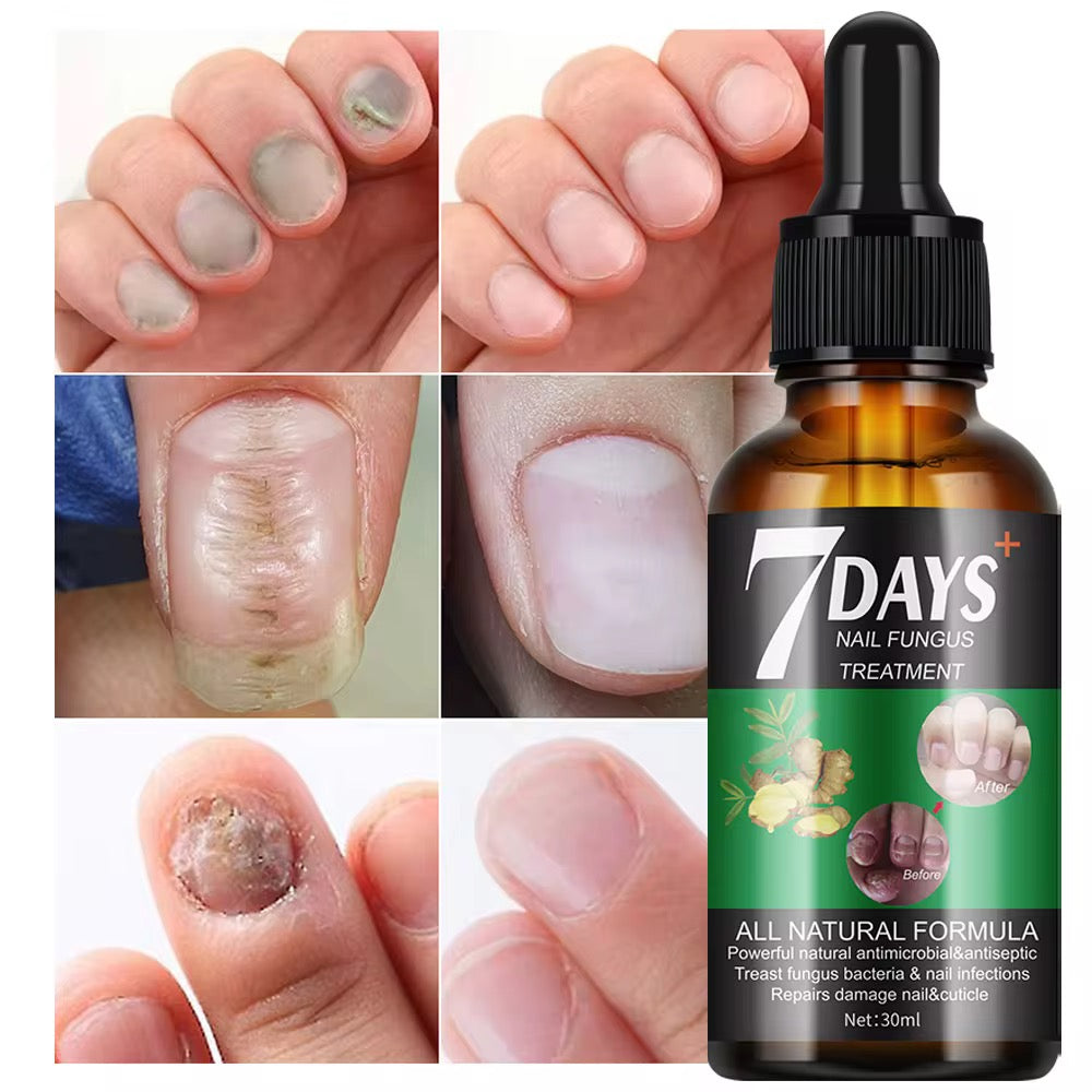 Traitement anti-mycoses des ongles (7 jours)