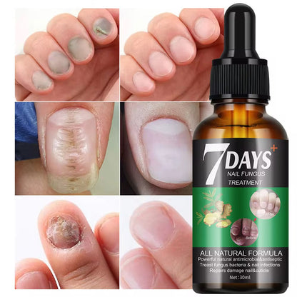Traitement anti-mycoses des ongles (7 jours)